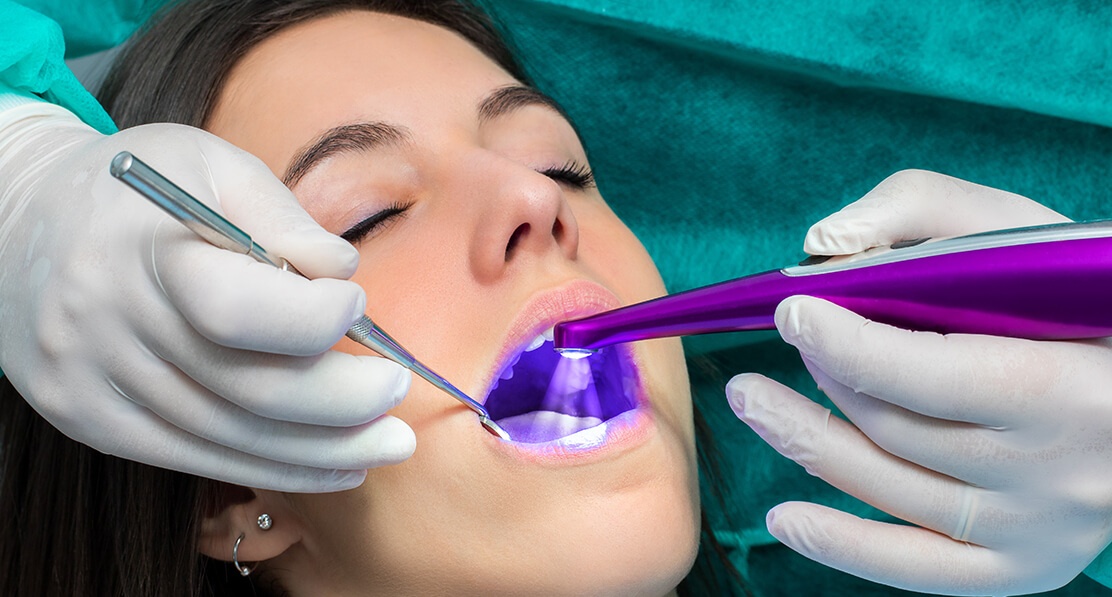 Sealants treatment in Houston